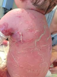 Nekrolisis Epidermal Toksik